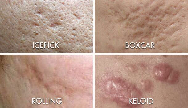 Acne scarring blog