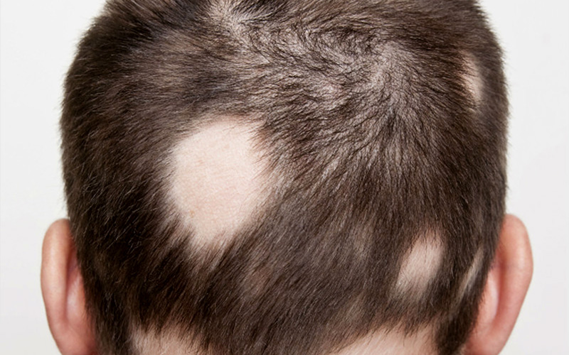 Alopecia Areata  Patchy Hair Loss with Unpredictable Course