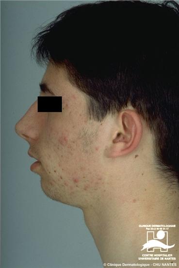 acne.jpg