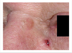 basal-cell-carcinoma_1.jpg