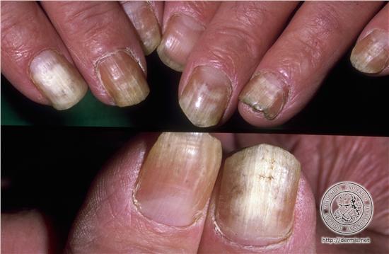 fungal nail infection