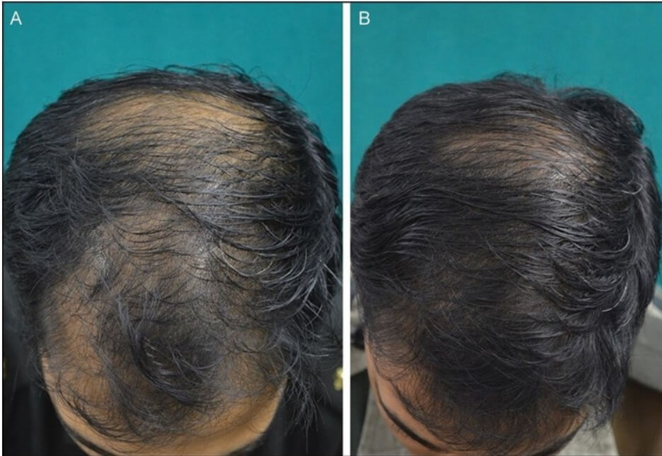 hair loss a