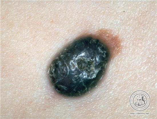 melanoma