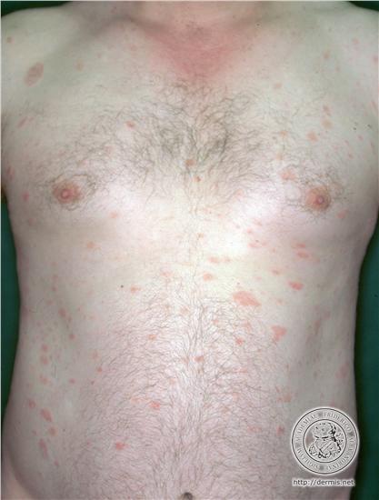 pityriasis rosea christmas tree pattern