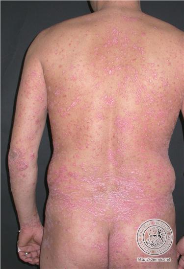 psoriasis