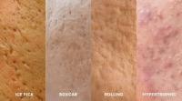 Acne Scarring