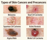 Skin Cancer