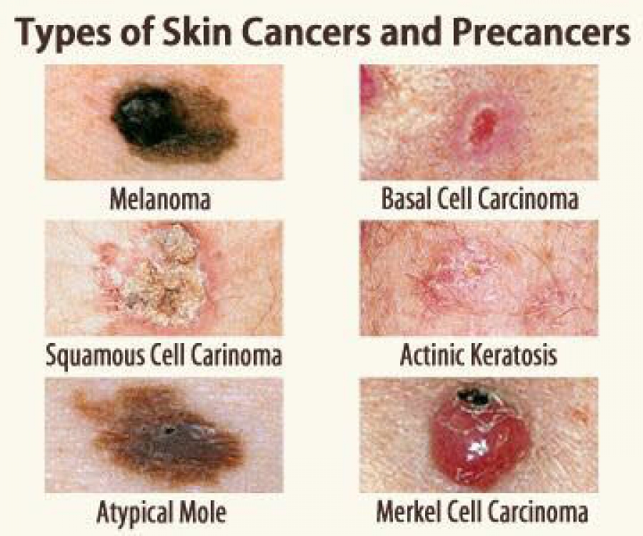 Skin Cancer Types Basal Cell Carcinoma (BCC) Squamous Cell Carcinoma ...